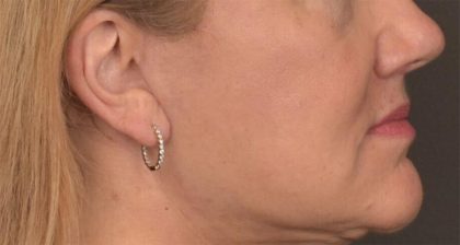 Lip Lift Before & After Patient #4169