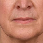 Lip Lift Before & After Patient #4170