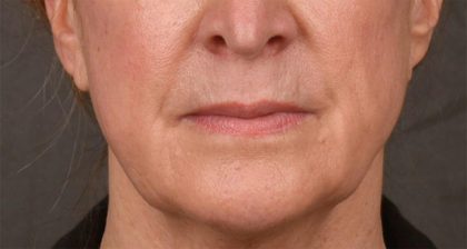 Lip Lift Before & After Patient #4170