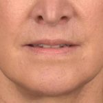 Lip Lift Before & After Patient #4170