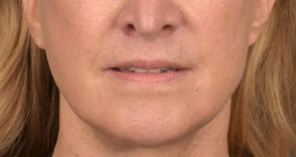 Lip Lift Before & After Patient #4170