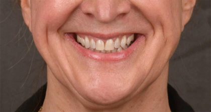 Lip Lift Before & After Patient #4170