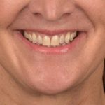 Lip Lift Before & After Patient #4170