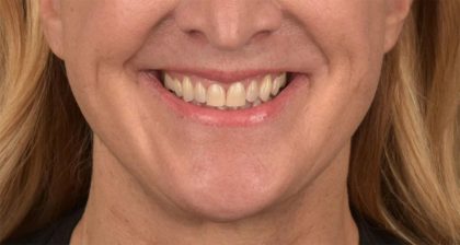 Lip Lift Before & After Patient #4170