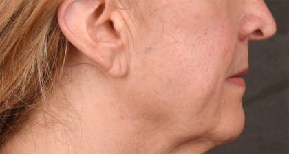 Lip Lift Before & After Patient #4170