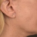 Lip Lift Before & After Patient #4170