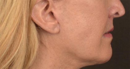 Lip Lift Before & After Patient #4170