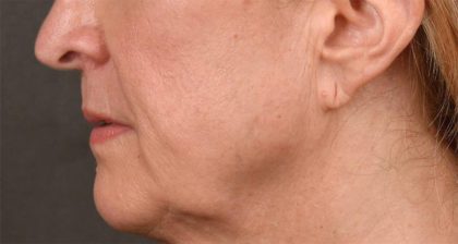 Lip Lift Before & After Patient #4170