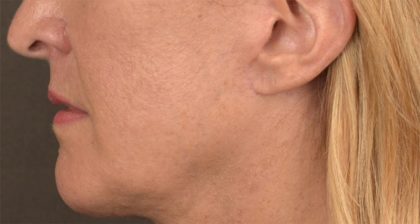 Lip Lift Before & After Patient #4170