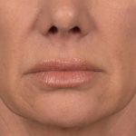 Lip Lift Before & After Patient #4167