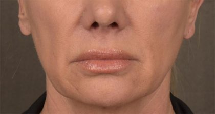Lip Lift Before & After Patient #4167