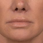 Lip Lift Before & After Patient #4167