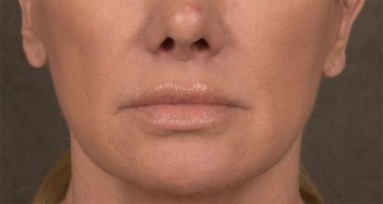 Lip Lift Before & After Patient #4167