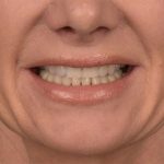 Lip Lift Before & After Patient #4167