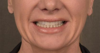 Lip Lift Before & After Patient #4167