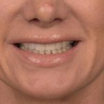 Lip Lift Before & After Patient #4167