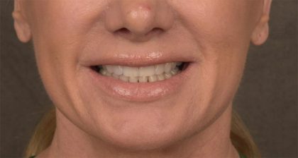 Lip Lift Before & After Patient #4167
