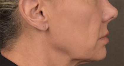 Lip Lift Before & After Patient #4167