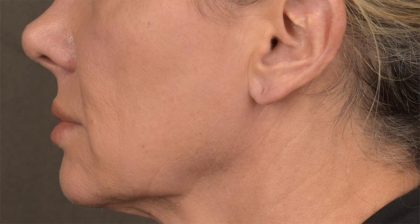 Lip Lift Before & After Patient #4167