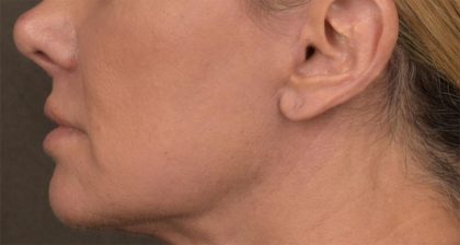 Lip Lift Before & After Patient #4167