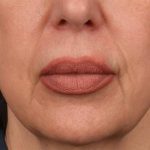 Lip Lift Before & After Patient #4166
