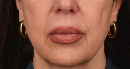Lip Lift Before & After Patient #4166