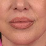 Lip Lift Before & After Patient #4166