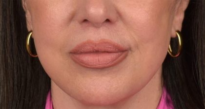 Lip Lift Before & After Patient #4166