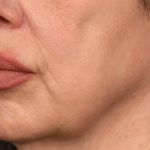 Lip Lift Before & After Patient #4166