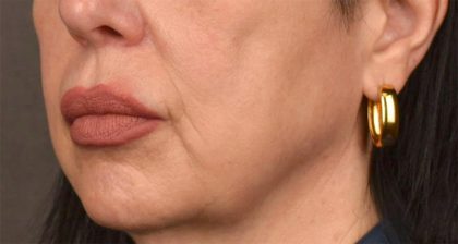 Lip Lift Before & After Patient #4166