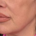Lip Lift Before & After Patient #4166