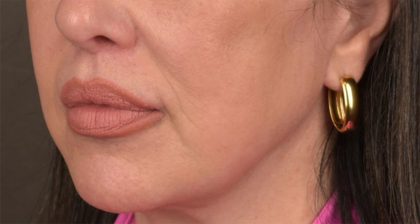 Lip Lift Before & After Patient #4166