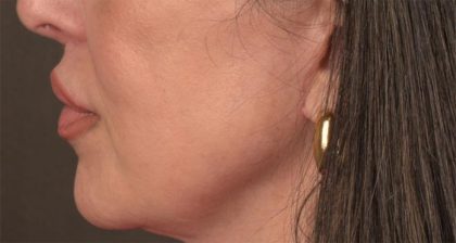 Lip Lift Before & After Patient #4166