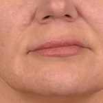 Lip Lift Before & After Patient #4168