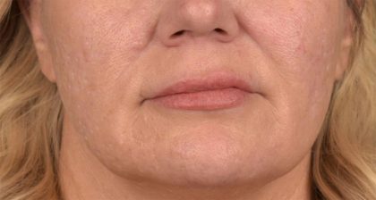 Lip Lift Before & After Patient #4168