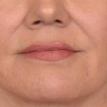 Lip Lift Before & After Patient #4168