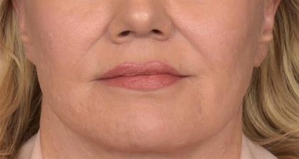 Lip Lift Before & After Patient #4168