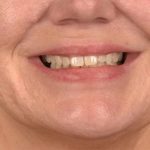 Lip Lift Before & After Patient #4168