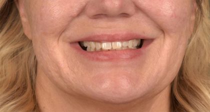 Lip Lift Before & After Patient #4168