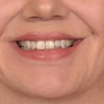 Lip Lift Before & After Patient #4168