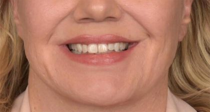 Lip Lift Before & After Patient #4168