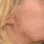 Lip Lift Before & After Patient #4168