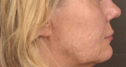 Lip Lift Before & After Patient #4168