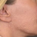 Lip Lift Before & After Patient #4168