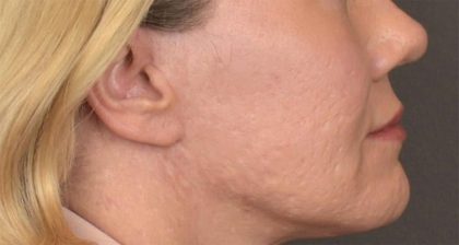 Lip Lift Before & After Patient #4168