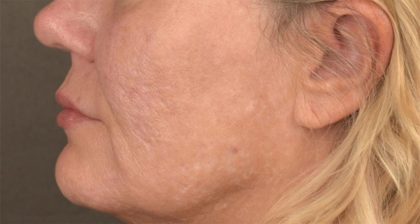 Lip Lift Before & After Patient #4168