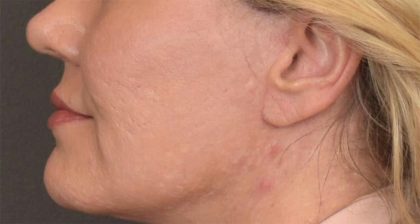 Lip Lift Before & After Patient #4168