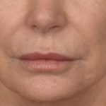 Lip Lift Before & After Patient #4171