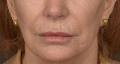 Lip Lift Before & After Patient #4171