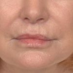 Lip Lift Before & After Patient #4171